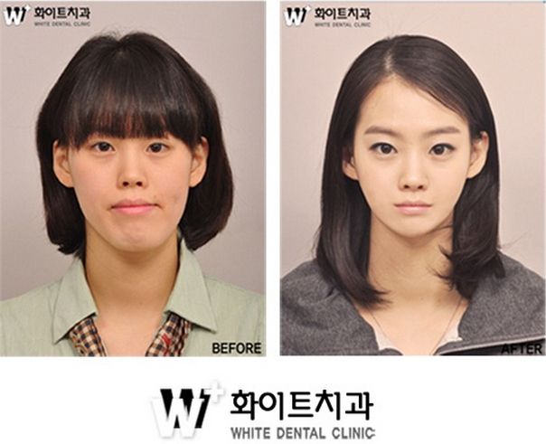 Korea Plastic Surgery Before and After: The Stunning Transformations Behind Seoul’s Beauty Revolution